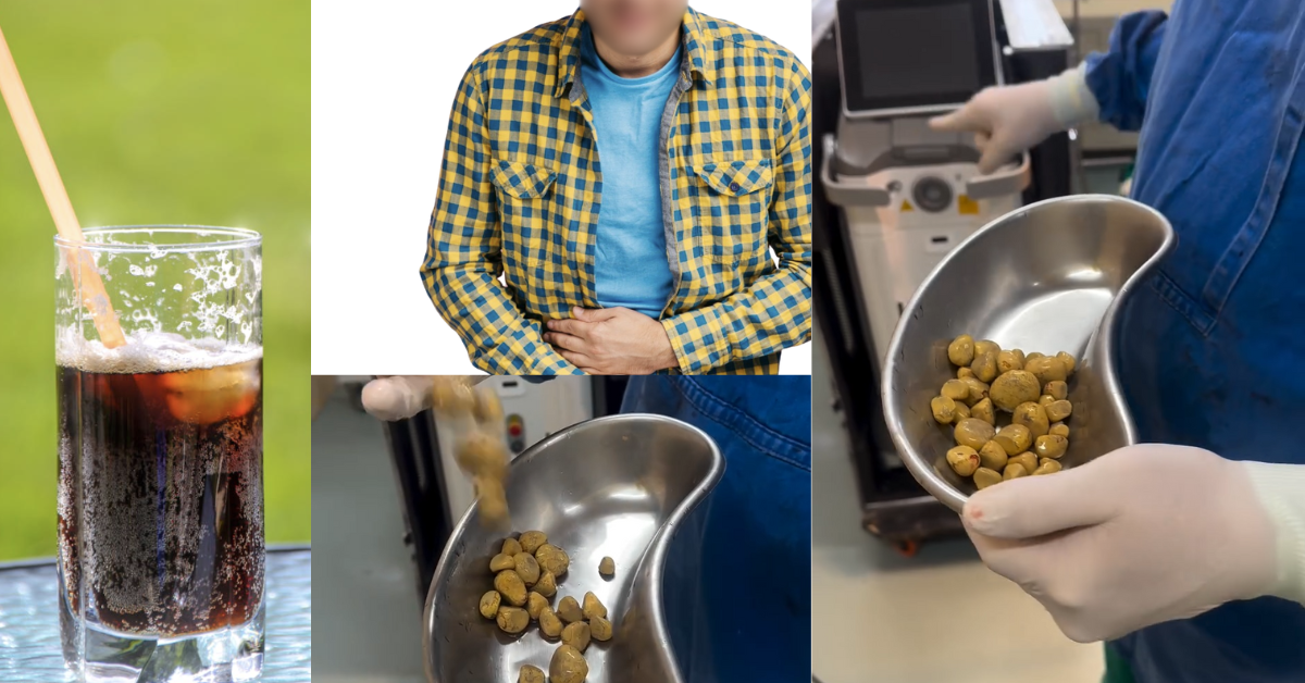 Man Develops 35 Bladder Stones After Drinking Cola Daily